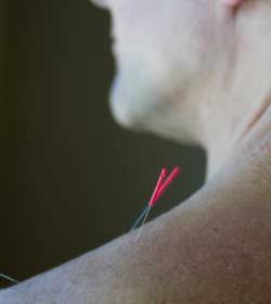 201886i106526_spaaccupuncture